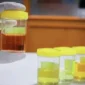 Jangan Abaikan Warna Urine, Ini Tanda yang Perlu Diwaspadai. (Foto: Pexels/suara)