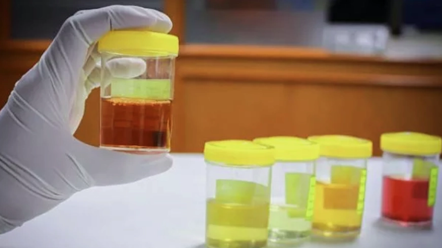 Jangan Abaikan Warna Urine, Ini Tanda yang Perlu Diwaspadai. (Foto: Pexels/suara)