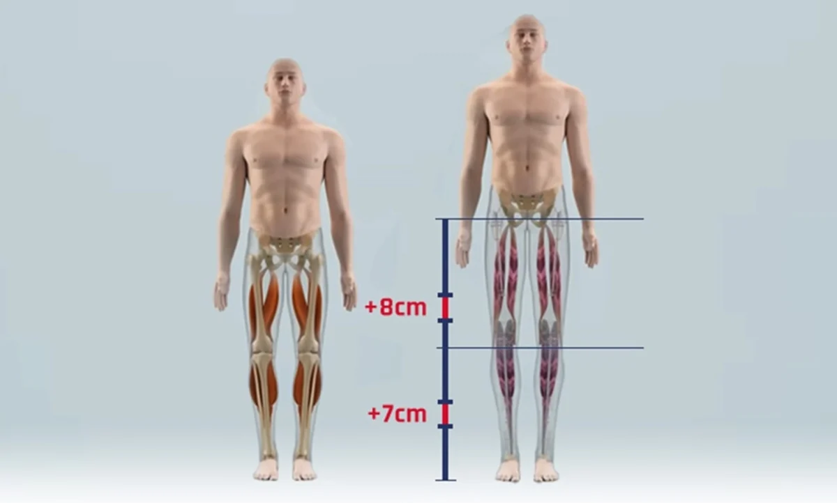 Operasi Tulang Kaki di Turki demi Menambah dan Mengurangi Tinggi Badan Kian Diminati, Ketahui Prosedur dan Risikonya. (Foto: cureindia)